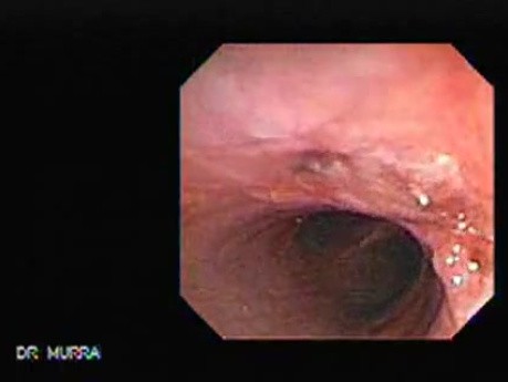 Traqueostomy Fistula (3 of 5)