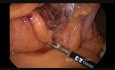 Laparoscopic Transverse Colon Resection for Cancer
