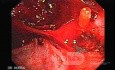 Severe Bleeding after Biopsies (7 of 7)