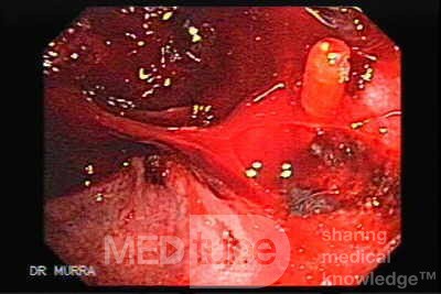Severe Bleeding after Biopsies (7 of 7)