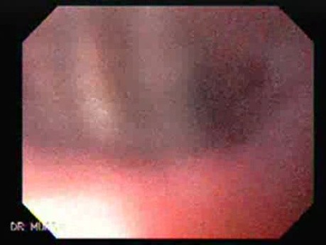 Esophageal Squamous Cell Carcinoma - Display of Gastric Cardias