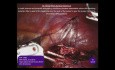 Robotic Partial Nephrectomy (NSS) using Quill Barbed Suture