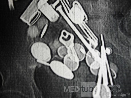 Multiple Foreign bodies in the GI tract (5 of 12)