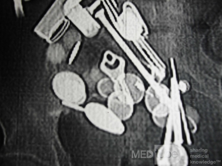 Multiple Foreign bodies in the GI tract (5 of 12)