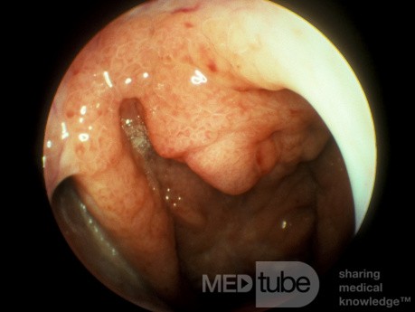 Carcinoma of the Nasopharynx