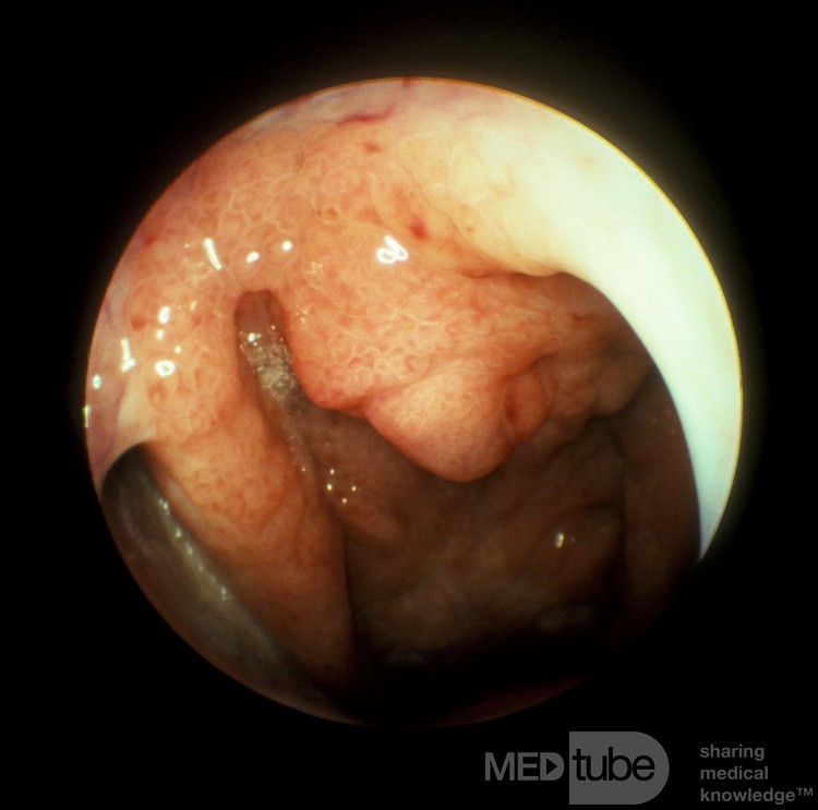 Carcinoma of the Nasopharynx