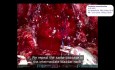Use of Quill® Barbed Suture in Robot-Assisted Radical Prostatectomy by Prof. Musi, Dr Luzzago and Prof. De Cobelli IEO Milan