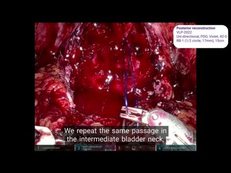 Use of Quill® Barbed Suture in Robot-Assisted Radical Prostatectomy by Prof. Musi, Dr Luzzago and Prof. De Cobelli IEO Milan