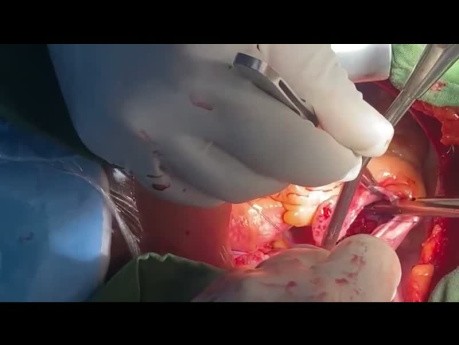 Off Pump TV Repair and Bacterial Endocarditis Evacuation with Zeraatian Technique