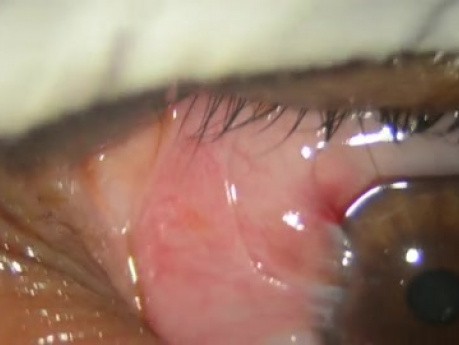 Bare Sclera Pterygium Surgery