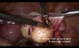 Standard Cystectomy for Ovarian Dermoid Cyst
