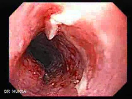 Esophageal Squamous Cell Carcinoma - 73 Year-Old Male
