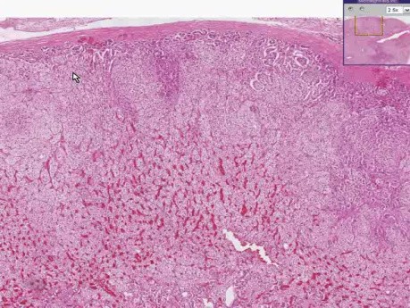 Adrenal - Nodular Hyperplasia