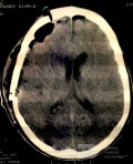 Acute Spontaneous Subdural Hemorrhage in the Subdural Space