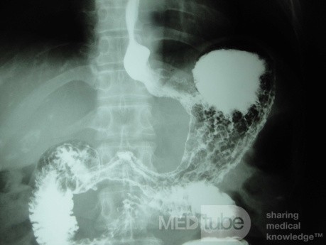 Endoscopy of Scirrhous Gastric Carcinoma involving the entire Fundus, Body and the Antrum (27 of 47)