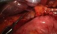 Laparoscopic Management Of Bleeding During Anatomical Liver Resection 
