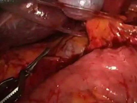 Laparoscopic Management Of Bleeding During Anatomical Liver Resection 