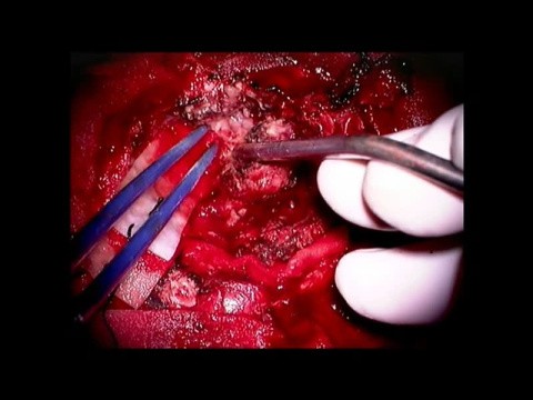 Neurochirurgie Live