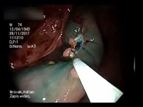 Piecemeal Ascending Colon LST-G Resection