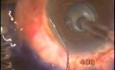 Failed Glaucoma Surgery - Re-Surgery