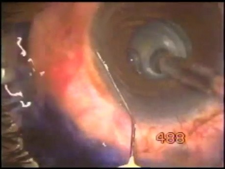 Failed Glaucoma Surgery - Re-Surgery