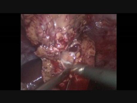 Laparoscopic Left Partial Nephrectomy