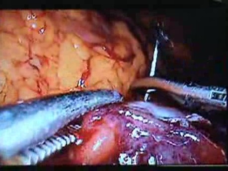 Jejunal Gastrointestinal Stromal tumor (GIST) (65 of 86)