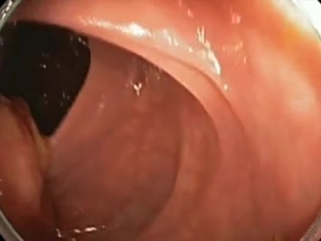 Colonoscopy - Transverse Colon Giant Polyp Resection - Part 1 of 2