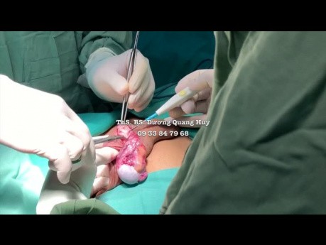 Microsurgical Varicocelectomy