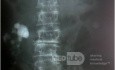 Nephrolithiasis Dextra