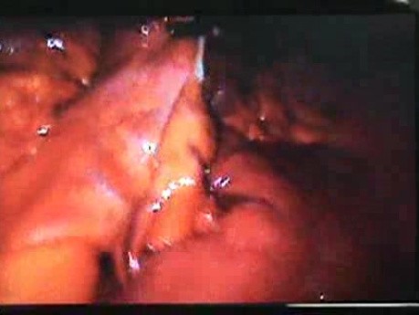 Jejunal Gastrointestinal Stromal tumor (GIST) (30 of 86)