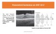 Hydroxychloroquine (Plaquenil) Retinopathy A Full Guide from A to Z