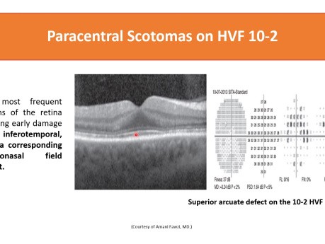 Hydroxychloroquine (Plaquenil) Retinopathy A Full Guide from A to Z