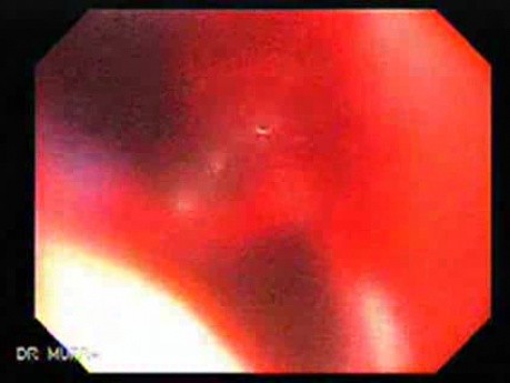 Recurrent Gastric Cancer after Gastrectomy Billroth II (6 of 6)