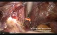 Total Laparoscopic Hysterectomy on Scar Abdomen