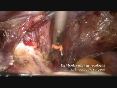 Total Laparoscopic Hysterectomy on Scar Abdomen