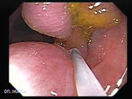 Colonoscopic Polypectomy (6 of 18)