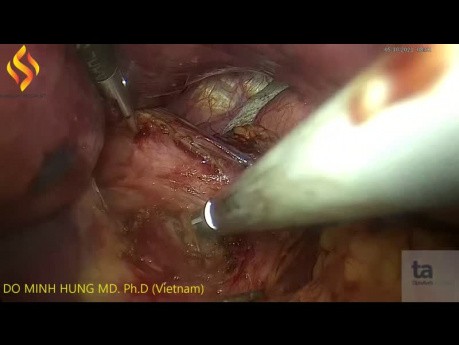 Lap Nissen Fundoplication for GERD