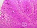 Histoplasmosis of the Colon and Condyloma Accuminata (11 of 11)