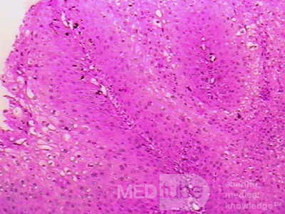 Histoplasmosis of the Colon and Condyloma Accuminata (11 of 11)