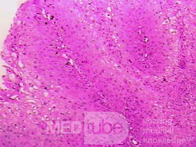 Histoplasmosis of the Colon and Condyloma Accuminata (11 of 11)