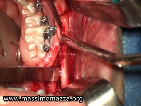 Orthognatic Surgery