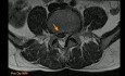 Unilateral Biportal Endoscopic Spine Surgery