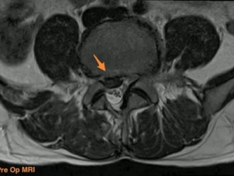 Unilateral Biportal Endoscopic Spine Surgery