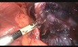 Adnexal Torsion Necrosis Annexectomy