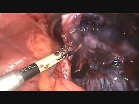 Adnexal Torsion Necrosis Annexectomy