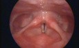 Nodules On The Vocal Folds
