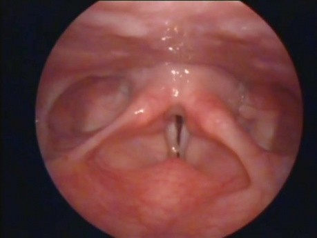 Nodules On The Vocal Folds