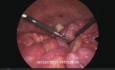 Laparoscopy for Diagnosing Intraperitoneal Malignancy, Application of Fagotti Score