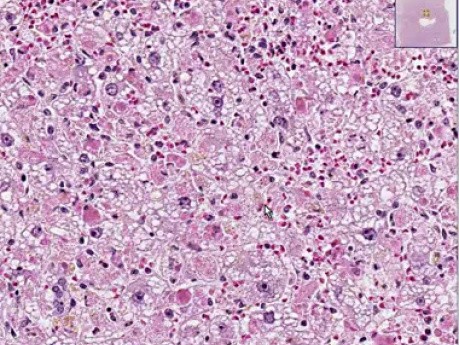 Hepatitis, yellow fever virus